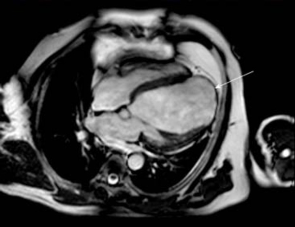 Calcified Left Ventricular Aneurysm: “An Egg in the Heart”